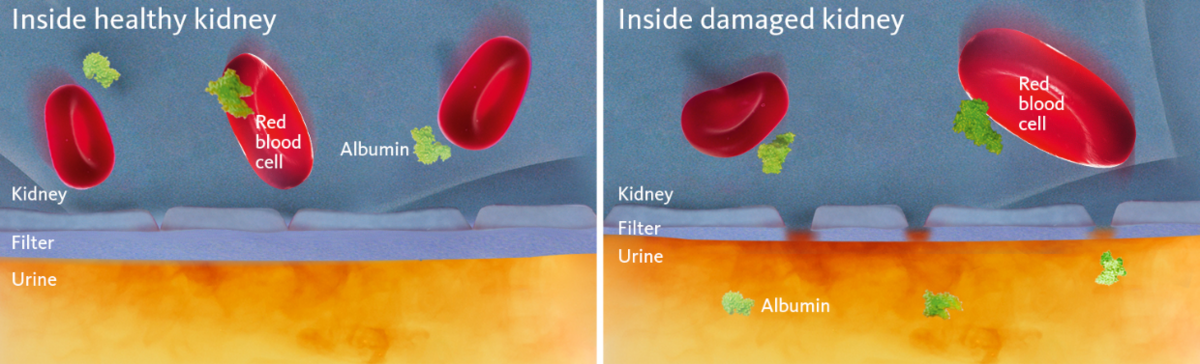 Schematic and simplified view of a healthy and a damaged kidney membrane with the latter illustrating the cause of albuminuria.