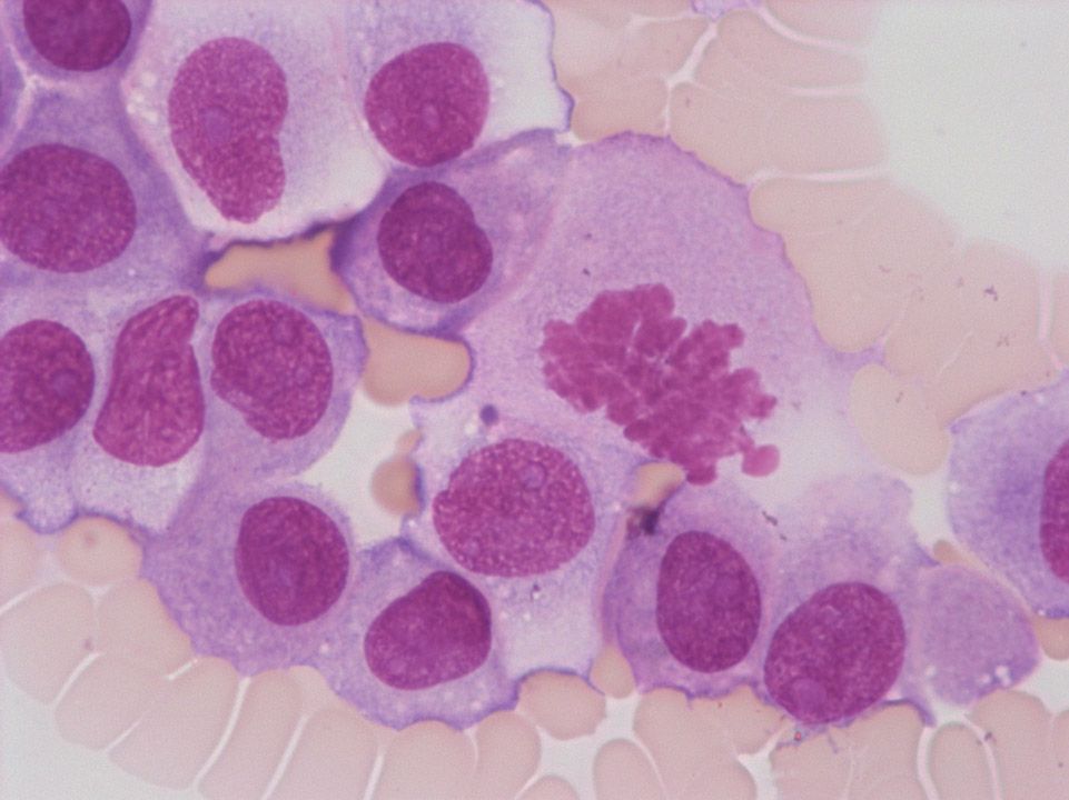 Malignant melanoma cells on blood film