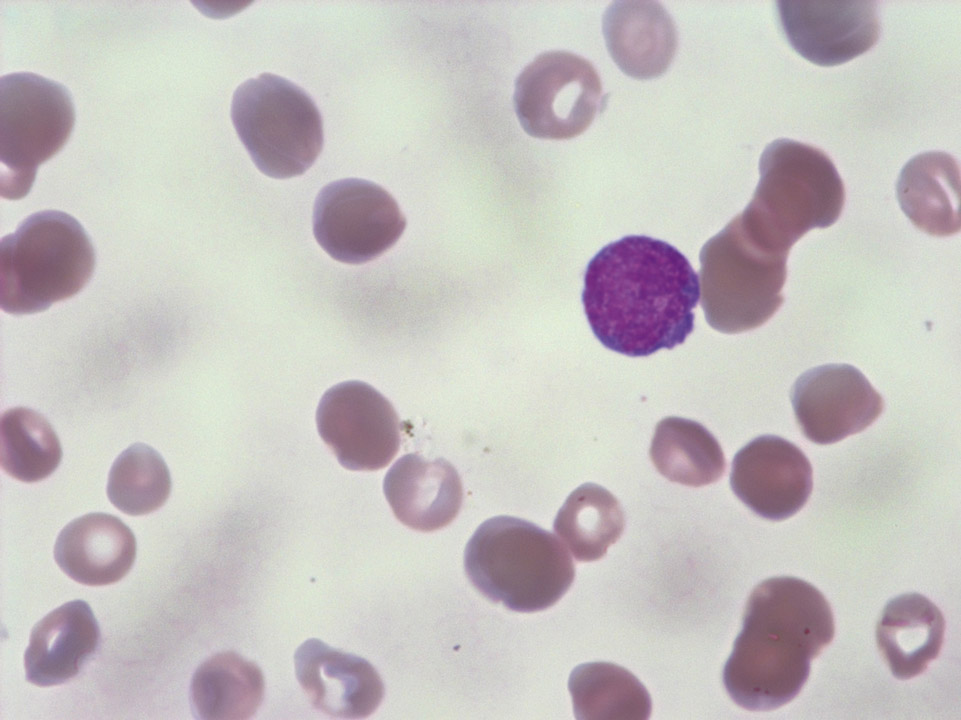 Blood film with striations with a blue cast