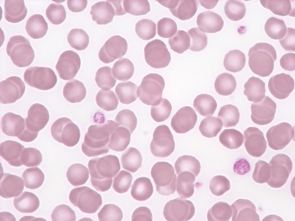 Thrombocytopenia and platelet anisocytosis