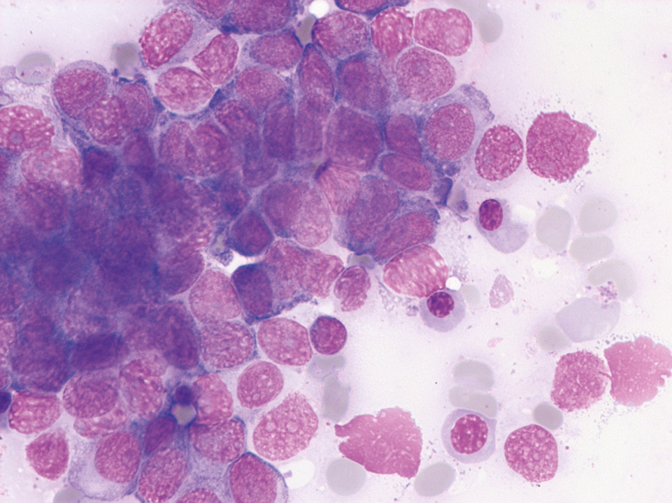 Bone marrow analysis of a breast cancer patient