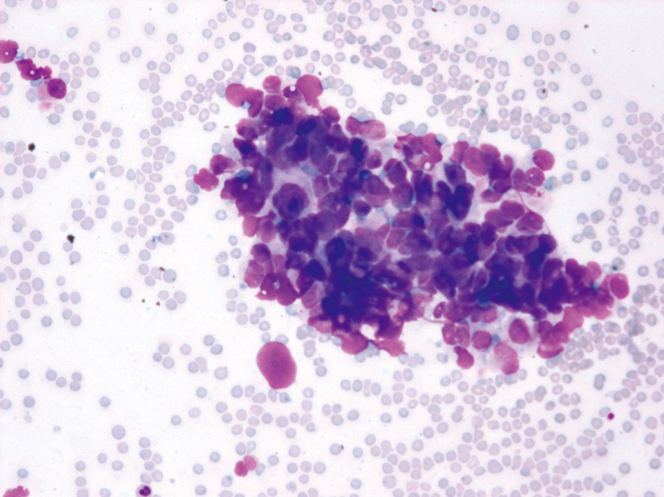Bone marrow cytology showing many tumour cells of breast cancer