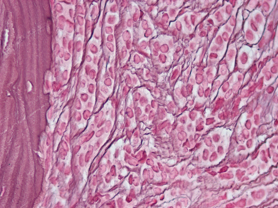 Infiltration of bone marrow by a lobular carcinoma of the breast